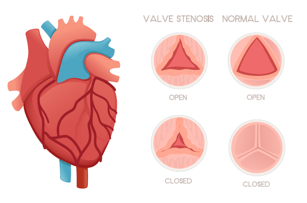 Aortic stenosis.PNG